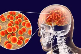 Ảnh minh họa về viêm não mô cầu.