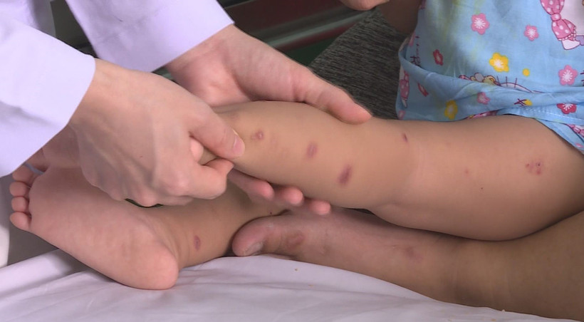 Trẻ nhiễm bệnh tay chân miệng tại thành phố Hồ Chí Minh. (Khánh Ly/Vietnam+)