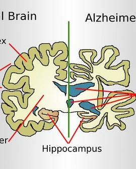 Bộ não của người mắc Alzheimer và của người bình thường. (Nguồn: Wikipedia)