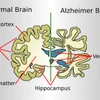 Bộ não của người mắc Alzheimer và của người bình thường. (Nguồn: Wikipedia)