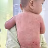 Thời điểm xuất viện, toàn bộ da bị bỏng nặng trước đây đã phục hồi hoàn toàn. (Ảnh: TTXVN phát)