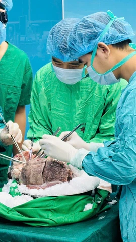 Các bác sỹ Bệnh viện Phổi Trung ương chuẩn bị thực hiện một ca ghép phổi. (Ảnh: PV/Vietnam+)