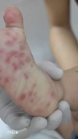 Các nốt phát ban của bệnh nhi bị tay chân miệng. (Ảnh: TTXVN/Vietnam+)