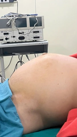 Khi bệnh nhân nhập viện, khối u đã phát triển rất to, tương đương thai 9 tháng. (Ảnh: PV/Vietnam+)