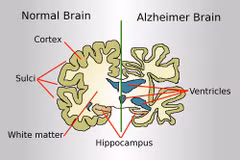 Bộ não của người mắc Alzheimer và của người bình thường. (Nguồn: Wikipedia)