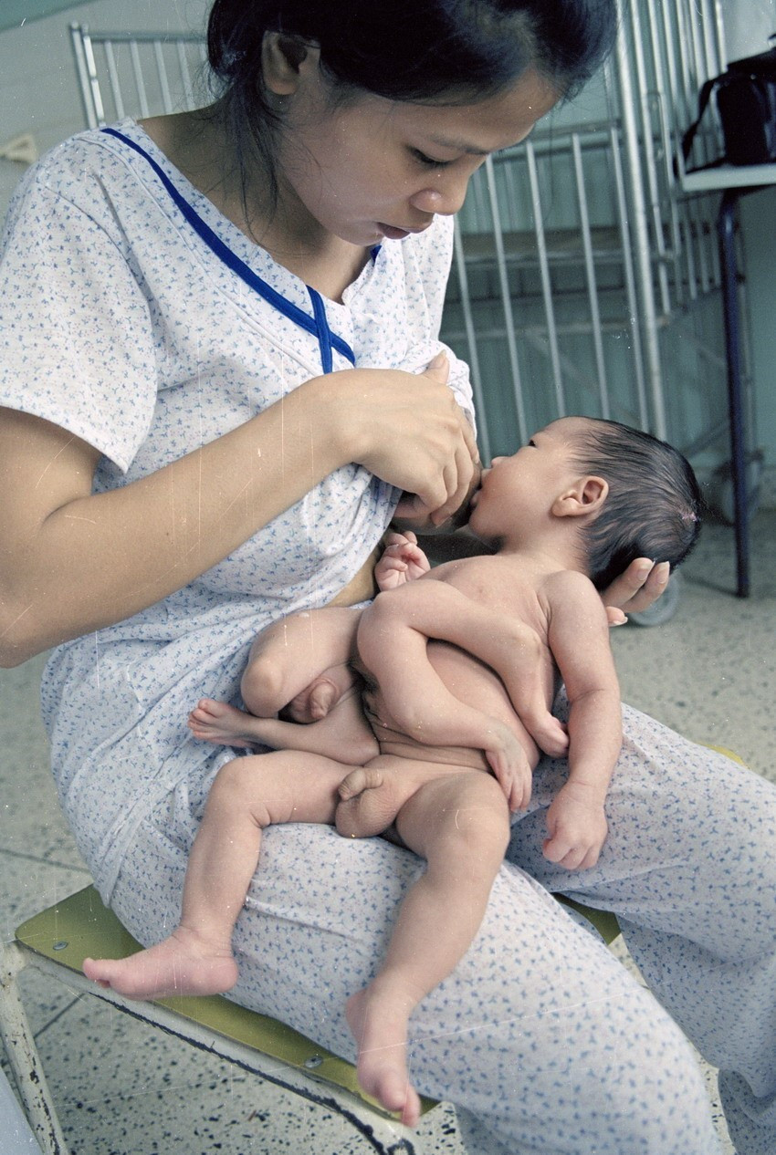 Cháu Lê Tiến Dũng, con anh Lê Hồng Tuyến, ở huyện Cam Lộ, tỉnh Quảng trị. Anh Tuyến từng tham gia chiến trường Quảng Trị thời kỳ chống Mỹ, bị ảnh hưởng chất độc da cam nên khi cháu Dũng sinh ra bị dị dạng do ảnh hưởng chất độc da cam/dioxin (2000). (Ảnh: Thu Hoài/TTXVN)