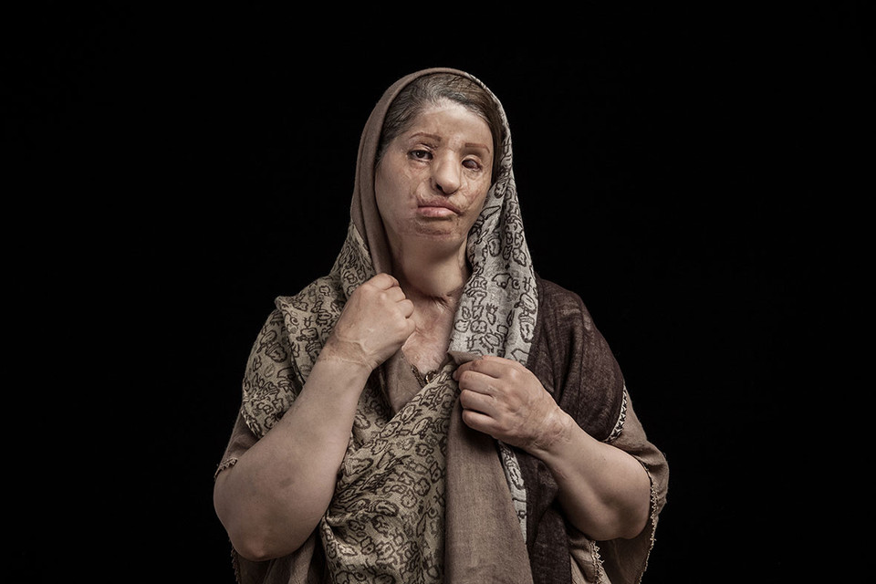 Mahnaz Kazemi (39 tuổi) ở tỉnh Qom, Iran. Khi cô quyết định ly dị thì chồng của cô đã tạt axít vào ngày 13/7/2007. Mahnaz mất mắt trái và một tai.