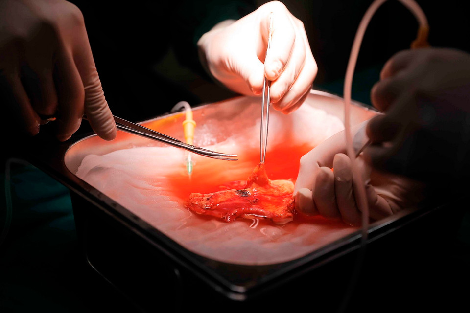 Khâu rửa thận trước khi ghép cho bệnh nhân. (Ảnh: Minh Quyết/TTXVN)