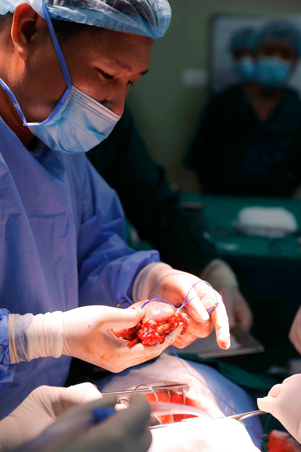 Bác sỹ tiến hành lấy thận từ người cho cùng huyết thống. (Ảnh: Minh Quyết/TTXVN)