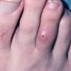 Vết thương do bệnh Myiasis. (Ảnh: medscape)