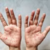 Một bệnh nhân bị mắc bệnh đậu mùa khỉ. (Ảnh: Shutterstock/TTXVN)
