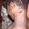 Bệnh nhân mắc đậu mùa khỉ tại CHDC Congo. (Ảnh: Getty Images/TTXVN)