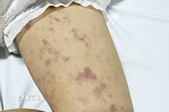 Bệnh nhi mắc viêm não mô cầu xuất hiện những xuất huyết dưới da trên da khắp cơ thể. (Ảnh: TTXVN phát)