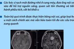 Lần đầu tiên phẫu thuật cắt bỏ khối u não qua vết mổ nội soi trên cung mày 
