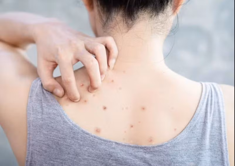 Mụn lưng là vấn đề nhiều người gặp phải. (Ảnh: iStock)