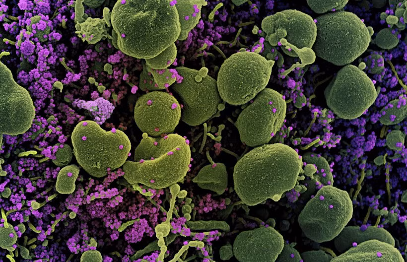 Hình ảnh quét qua kính hiển vi điện tử cho thấy tế bào (màu xanh) bị virus SARS-COV-2 (màu tím) xâm nhập. (Ảnh: AFP/TTXVN)