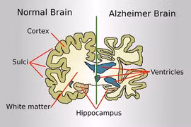 Bộ não của người mắc Alzheimer và của người bình thường. (Nguồn: Wikipedia)