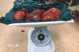 Khối u xơ tử cung được phẫu thuật lấy ra từ một bệnh nhân nữ tại thành phố Vũng Tàu. (Ảnh: Hoàng Nhị/TTXVN)