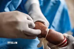 Nhân viên y tế điều trị cho bệnh nhân mắc đậu mùa khỉ. (Ảnh: THX/TTXVN)