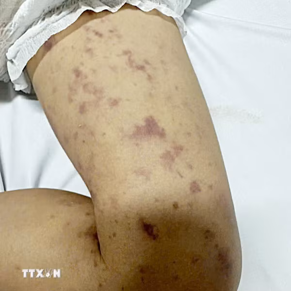TP Hồ Chí Minh: Xác định thêm một học sinh dương tính với não mô cầu nhóm B