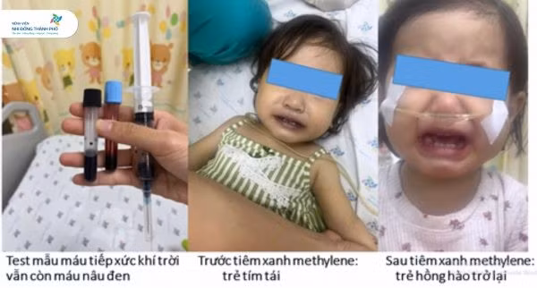 Bé gái tím tái, nguy kịch sau khoảng 1 giờ ăn ghẹ và canh cải bó xôi nấu với nước giếng. (Nguồn: Bệnh viện Nhi đồng Thành phố)