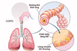 Ghép tế bào gốc tự thân để điều trị bệnh phổi tắc nghẽn mạn tính