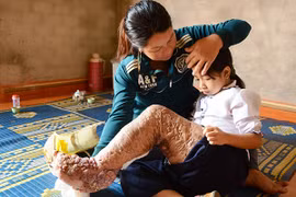 Bé Nguyễn Thị Loan khi phải chung sống với cái 'chân voi' sần sùi, đau đớn. (Ảnh: Báo Lâm Đồng)