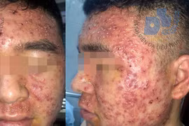 Bệnh nhân nhập viện với tình trạng nhiều mụn mủ, mụn bọc đầy mặt. (Ảnh: PV/Vietnam+)
