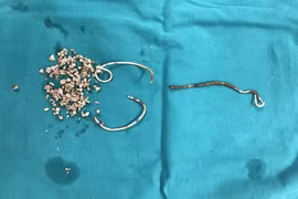 Rất nhiều viên sỏi và stent bị gãy làm ba đoạn. (Ảnh: PV/Vietnam+)