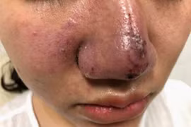 Một bệnh nhân gặp biến chứng nặng nề sau tiêm filler làm đẹp. (Ảnh: Bệnh viện Da liễu cung cấp)