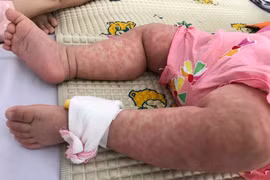 Một bệnh nhi mắc sởi, phát ban toàn thân. (Ảnh: TTXVN
