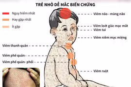 Bệnh sởi và những biến chứng nguy hiểm ở trẻ em.