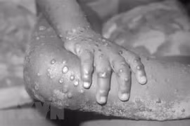 Một em nhỏ mắc bệnh đậu mùa khỉ. (Ảnh: Getty Images/TTXVN) 