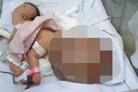 Phẫu thuật khối bướu nặng 3,1kg cho bé sơ sinh mới 1 ngày tuổi