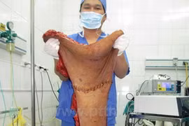 Khối u của bệnh nhân được các bác sỹ tách ra sau khi phẫu thuật. (Ảnh: PV/Vietnam+)