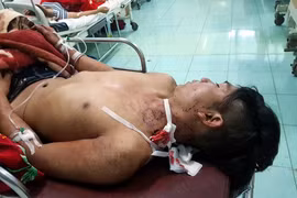 Bệnh nhân Điểu Khuê nhập viện trong tình trạng nguy kịch. (Ảnh: Bệnh viện cung cấp/TTXVN phát)
