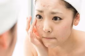 Thực hành chu trình 3 bước đơn giản để đẩy lùi làn da nổi mụn sau Tết