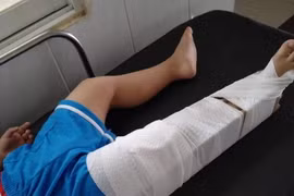 Tạm đình chỉ công tác giáo viên làm bé trai 3 tuổi gãy xương đùi
