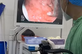 Cứu sống bệnh nhân tâm thần nuốt cây kéo và thanh kim loại vào bụng