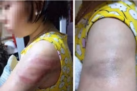 Tạm đình chỉ công tác cô giáo dùng thước đánh vào tay học sinh