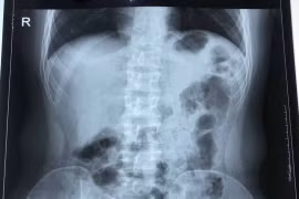 Phim chụp của bệnh nhân viêm ruột thừa cấp có phủ tạng đảo ngược hoàn toàn cực kỳ hiếm gặp. (Ảnh: PV/Vietnam+)