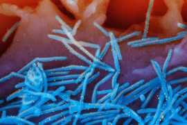 Hình ảnh virus hợp bào hô hấp ở người chụp bằng kính hiển vi điện tử có màu, với virus màu xanh lam và kháng thể màu vàng, bong ra khỏi bề mặt tế bào phổi người. (Nguồn: The New York Times)