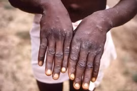Bệnh nhân mắc đậu mùa khỉ ở Cộng hòa Dân chủ Congo. (Nguồn: Getty Images/TTXVN)
