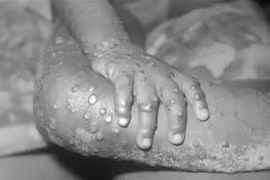 Một em nhỏ mắc bệnh đậu mùa khỉ. (Ảnh: Getty Images/TTXVN) 