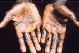 Một bệnh nhân mắc đậu mùa khỉ được điều trị tại trung tâm y tế ở Lodja, CHDC Congo. (Ảnh: Reuters/TTXVN)