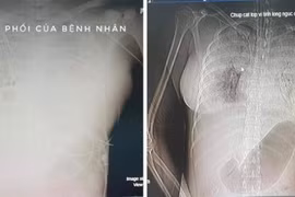 Hình chụp CT có thuốc cản quang cho thấy có nhiều ổ xuất huyết lớn. (Nguồn: vov.vn)