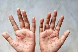 Các ban đỏ nổi trên tay một bệnh nhân mắc đậu mùa khỉ. (Ảnh: Shutterstock/TTXVN)
