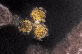 Hình ảnh quét qua kính hiển vi điện tử cho thấy virus SARS-COV-2 trên một mẫu bệnh phẩm của bệnh nhân COVID-19. (Ảnh: AFP/TTXVN)
