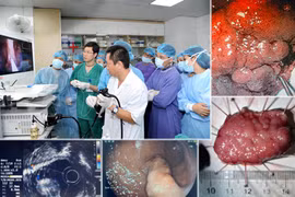 Cắt tách niêm mạc qua nội soi cho bệnh nhân có khối u lớn ở dạ dày