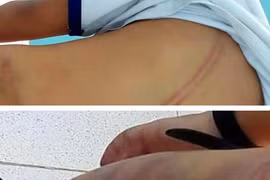 Các vết bầm trên người bé T. do bị mẹ kế đánh, (Ảnh: Báo Người Lao Động)